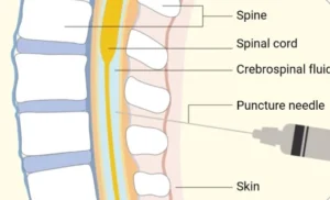 How Safe Is Intrathecal Drug Delivery?